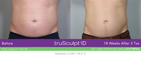 TruSculpt ID .